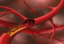 kaip sumazinti cholesteroli kraujyje be vaistu