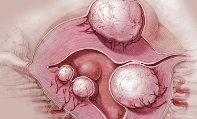 Kai mano ginekologas praneša apie cista ar mioma, aš geriu TAI ir visos mano problemos išnyksta per 4 dienas! 1 mioma